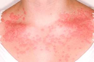 Аллергия с температурой у взрослого