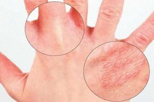 Аллергия на лампу для сушки ногтей
