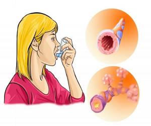Приступ удушья при бронхиальной астме
