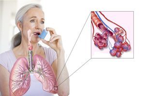 Лекарства при бронхиальной астме