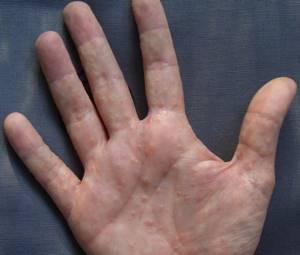Лечение дерматита на руках у взрослых