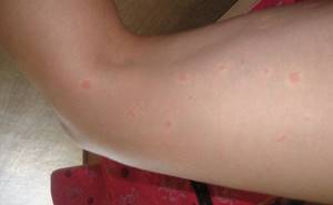 Аллергия на теле красные пятна