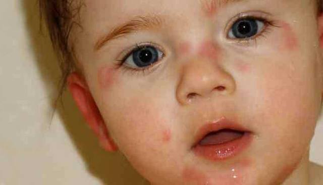 Как определить на что аллергия у ребенка