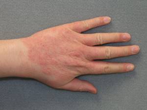 Атопический дерматит на руках