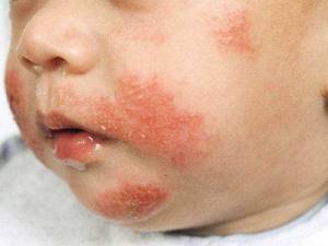 Диета при аллергии у детей