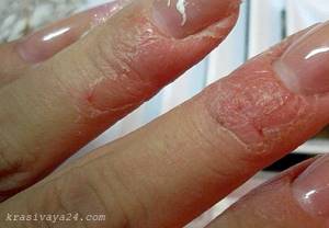 Аллергия на гель для наращивания ногтей