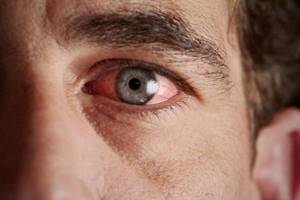 Зуд в глазах при аллергии лечение