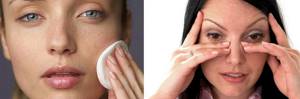 Как убрать аллергию с лица