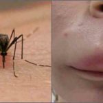 Аллергия на комаров у детей