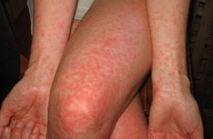 Аллергия после антибиотиков