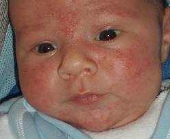 Аллергия на каши у ребенка