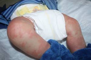 От аллергии грудному ребенку