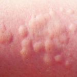 Аллергия в виде волдырей у ребенка