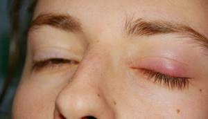 Опухли глаза от аллергии что делать