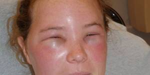 Опухли глаза от аллергии что делать