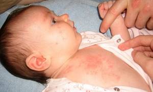 Аллергия на лице у грудничка лечение