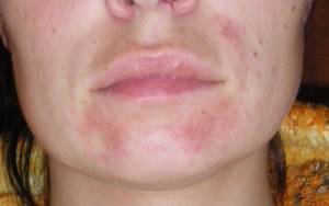 Аллергия на подбородке у женщин