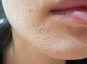 Крем от аллергии на лице