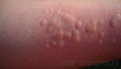Аллергическая реакция на укус комара