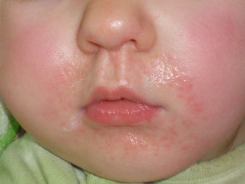 Аллергия на подбородке