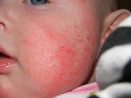 Аллергия на аквадетрим у грудничков