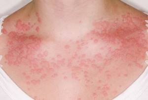 Аллергия на соевый соус симптомы