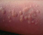Аллергия по типу крапивницы лечение
