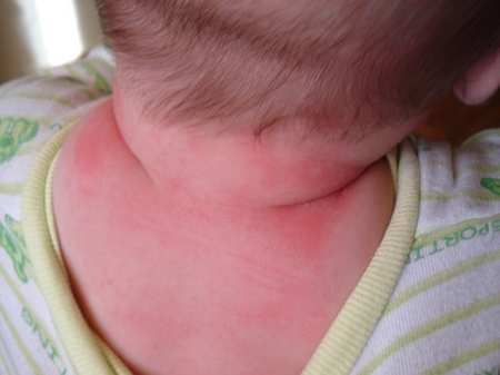 У ребенка аллергия на коровий белок