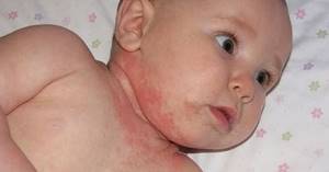 Токсико аллергический дерматит у детей
