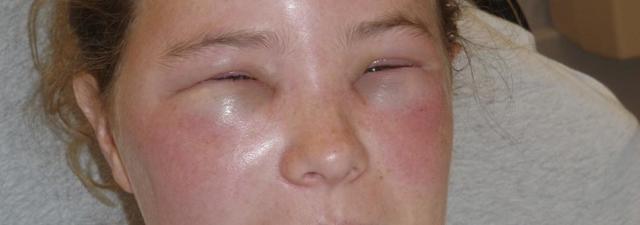 Аллергия на кефир
