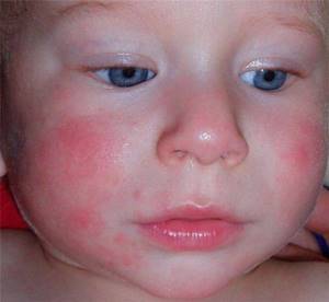 Аллергия на курицу у ребенка
