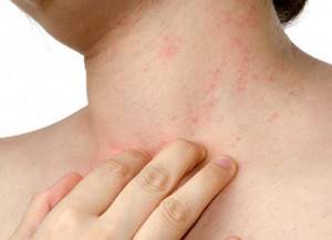 Аллергия на теле