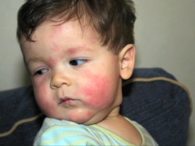 Как лечиться от аллергии в домашних условиях