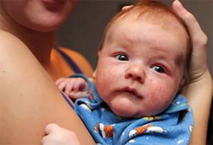 Аллергия на молочное у ребенка