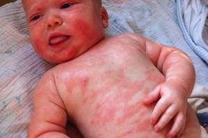 Аллергический дерматит у новорожденных