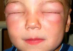 Аллергический отек лица лечение