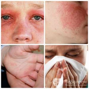 Холодовая аллергия лечение