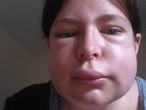 Красные пятна на лице аллергия чем лечить
