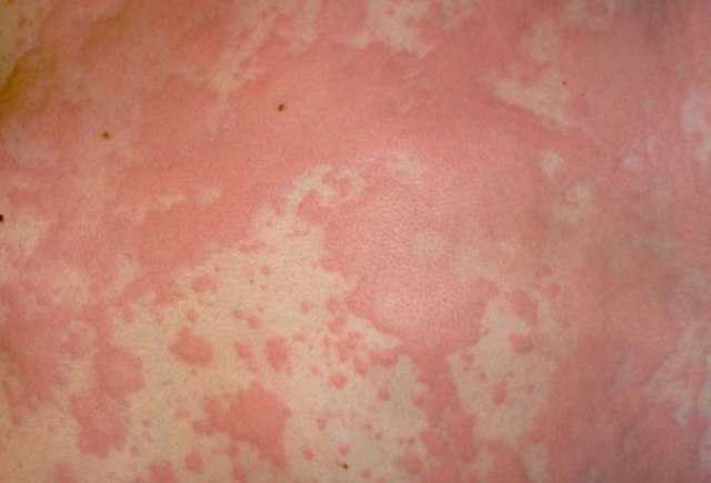 Лекарства при аллергии на коже