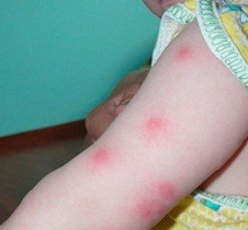 Укусы комаров у детей лечение