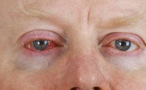 Аллергия на коже вокруг глаз