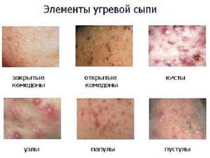 Аллергия на подбородке у женщин