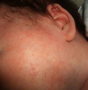 Аллергия на тыкву у ребенка