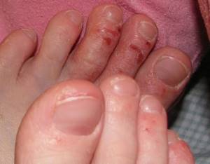 Инфекционный дерматит на ногах