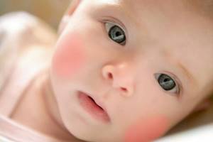 Чем лечить аллергию у младенца