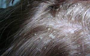 Себорейный дерматит кожи головы лечение