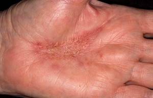 Кожный дерматит на руках