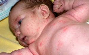Аллергия на малютку