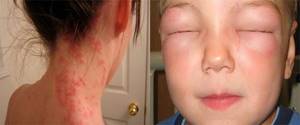 Аллергия на зиртек
