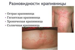 Аллергический зуд кожи лечение